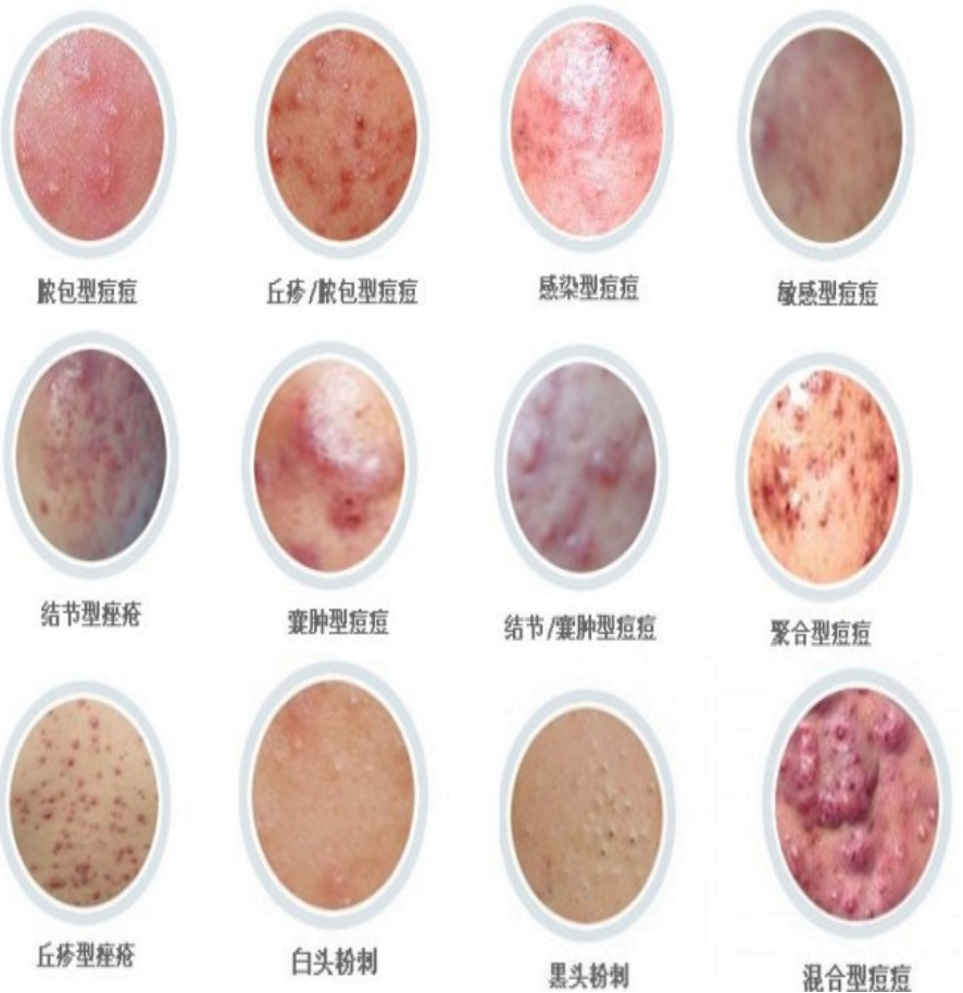 常见的皮肤问题(痘痘)