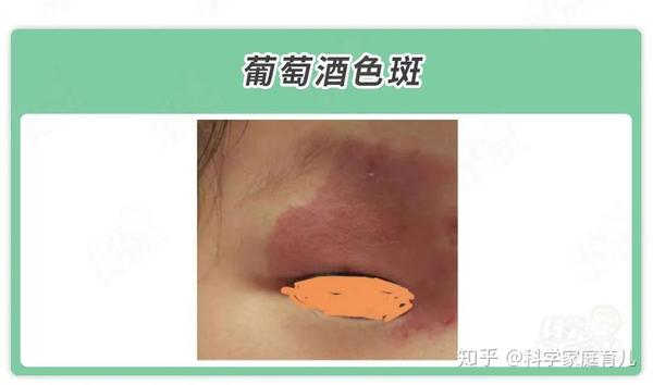 图片来源:科学家庭育儿原创  葡萄酒色斑 名字很好听,样子却很吓人