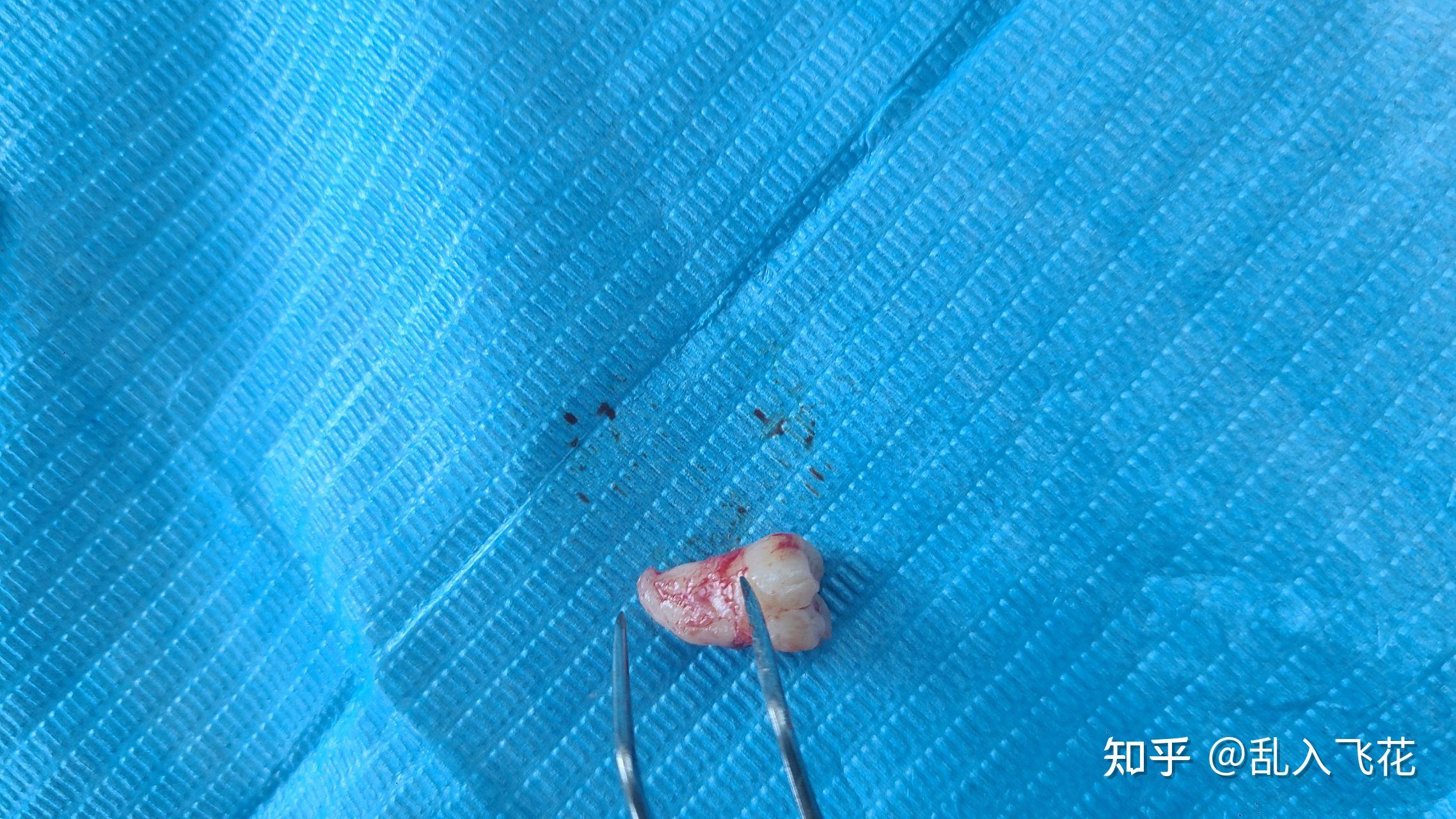 大家的智齿都长什么样啊?