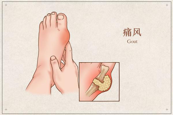 痛风是一种代谢性疾病,主要发生在身体的关节部位,其中最常发病的关节