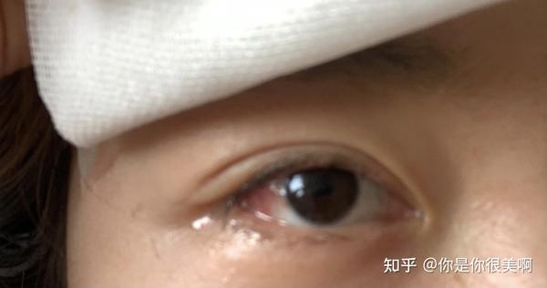 关于结膜色素痣的记录
