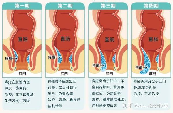 第五问:痔疮该如何预防?