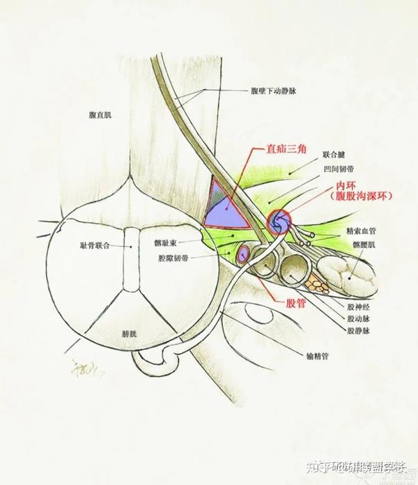 腹外疝 海氏三角:腹直肌外侧缘 腹股沟韧带 腹壁下动脉 calot三角