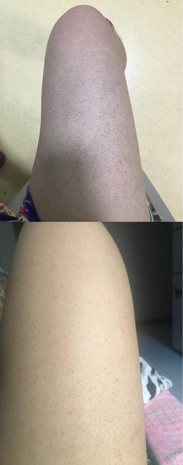 怎么去鸡皮肤?