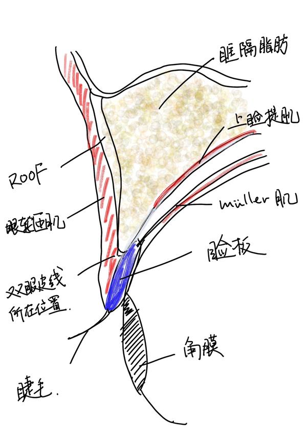 可以形成皮肤-眼轮匝肌与睑板-上睑提肌腱膜之间的直接连接 单睑解剖