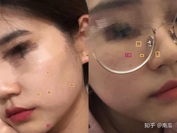我的手术77激光祛痣恢复过程记录