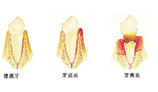 有牙周病可以进行牙齿矫正吗