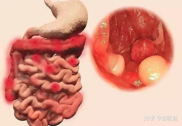 千万别小看肠道发出的这些信号,很有可能是癌症的预警