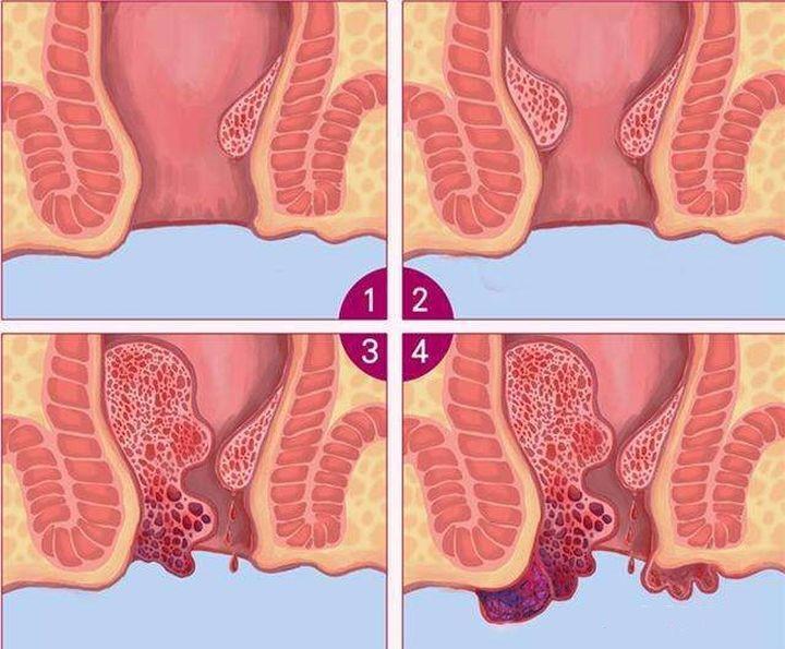 痔疮分4级对号入座看看你是哪一级