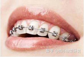 2021杭州牙齿矫正攻略,正畸价格|公立医院vs私立医院区别,正畸医生