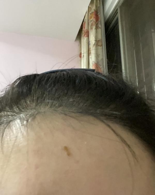 陈代谢比较慢)于是乎在第八天我忍不住把快要脱落的痂用手扣掉了很多