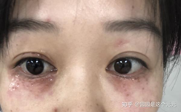 我眼周汗管瘤的治疗之路