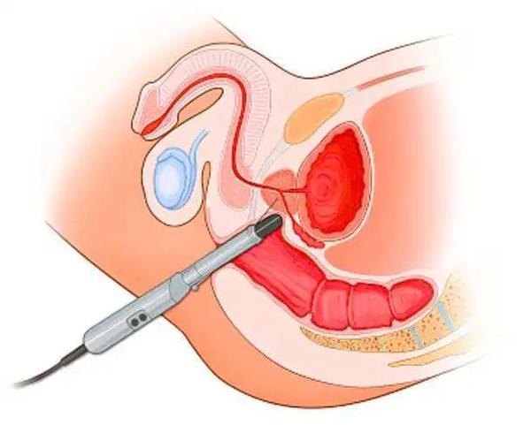 尤其是在前列腺按摩液不能够取得的情况下.