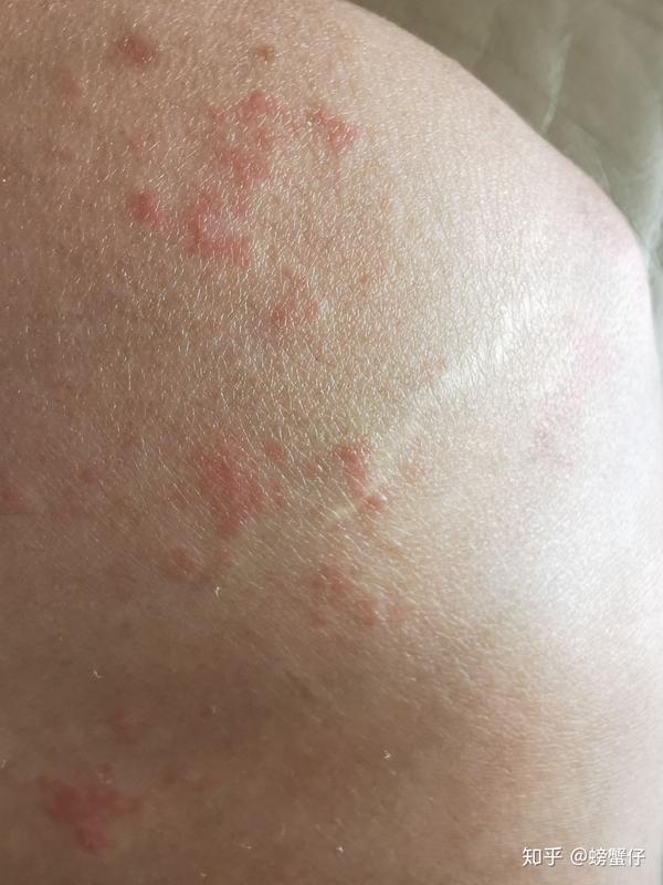 我的丘疹性荨麻疹,差不多三个月