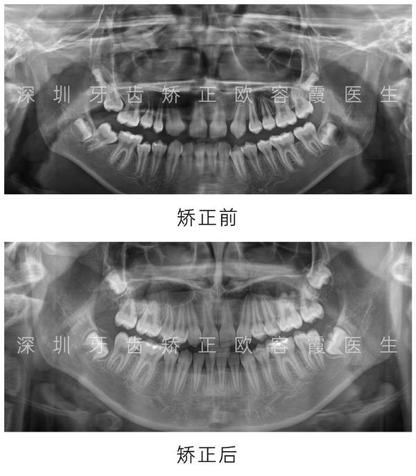 深圳牙齿矫正案例欧容霞篇│上颌先天缺失侧切牙,下颌