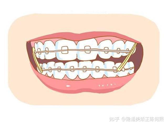 【深圳牙齿矫正】影响牙齿矫正速度的因素有哪些?