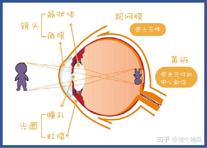 糖尿病视网膜病变伴黄斑水肿夺走视力的无声杀手