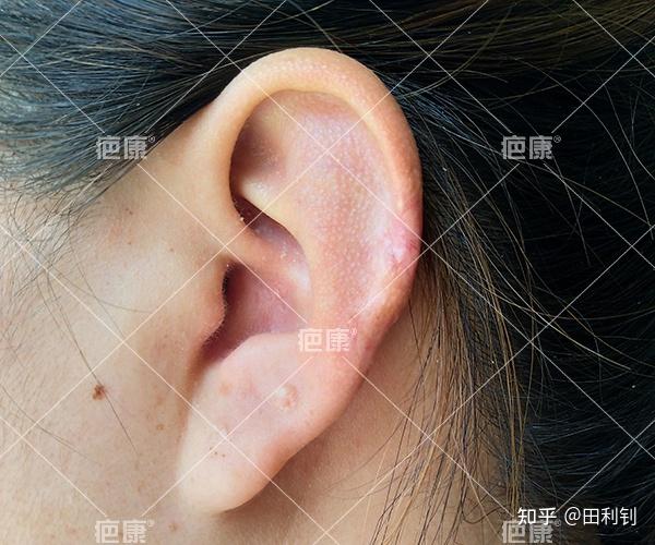 疤痕疙瘩 治疗周期: 5 李女士5年前因打耳洞致双侧耳廓凸起疙瘩,一年