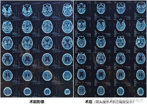 正常颅压脑积水是一种成人的慢性脑积水,常见于60岁以上的老年人,通常