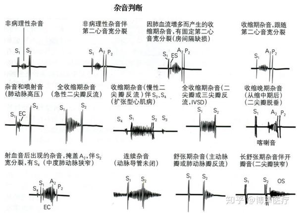 杂音的分类是根据它们的强度,持续时间,部位,性质如渐强,渐弱,吹风样
