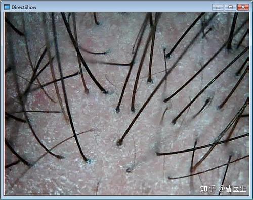 很多处于轻微脱发的患者,仅靠肉眼识别很难判断出自己的头发分布密度