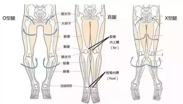 如何矫正罗圈腿o型腿