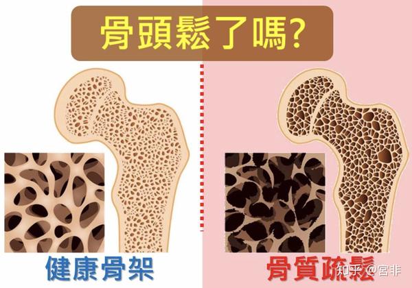 骨质疏松是一种以骨量低,骨组织微结构损坏,骨脆性增加,易发生骨折为