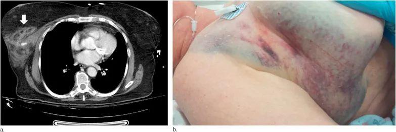 a胸部的ct显示右乳房有血肿 b图像显示了右乳房的淤青