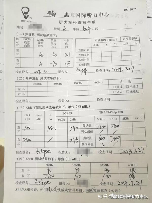 各项裸耳听力报告声导抗左耳as型右耳a型 dpoae双耳未通过