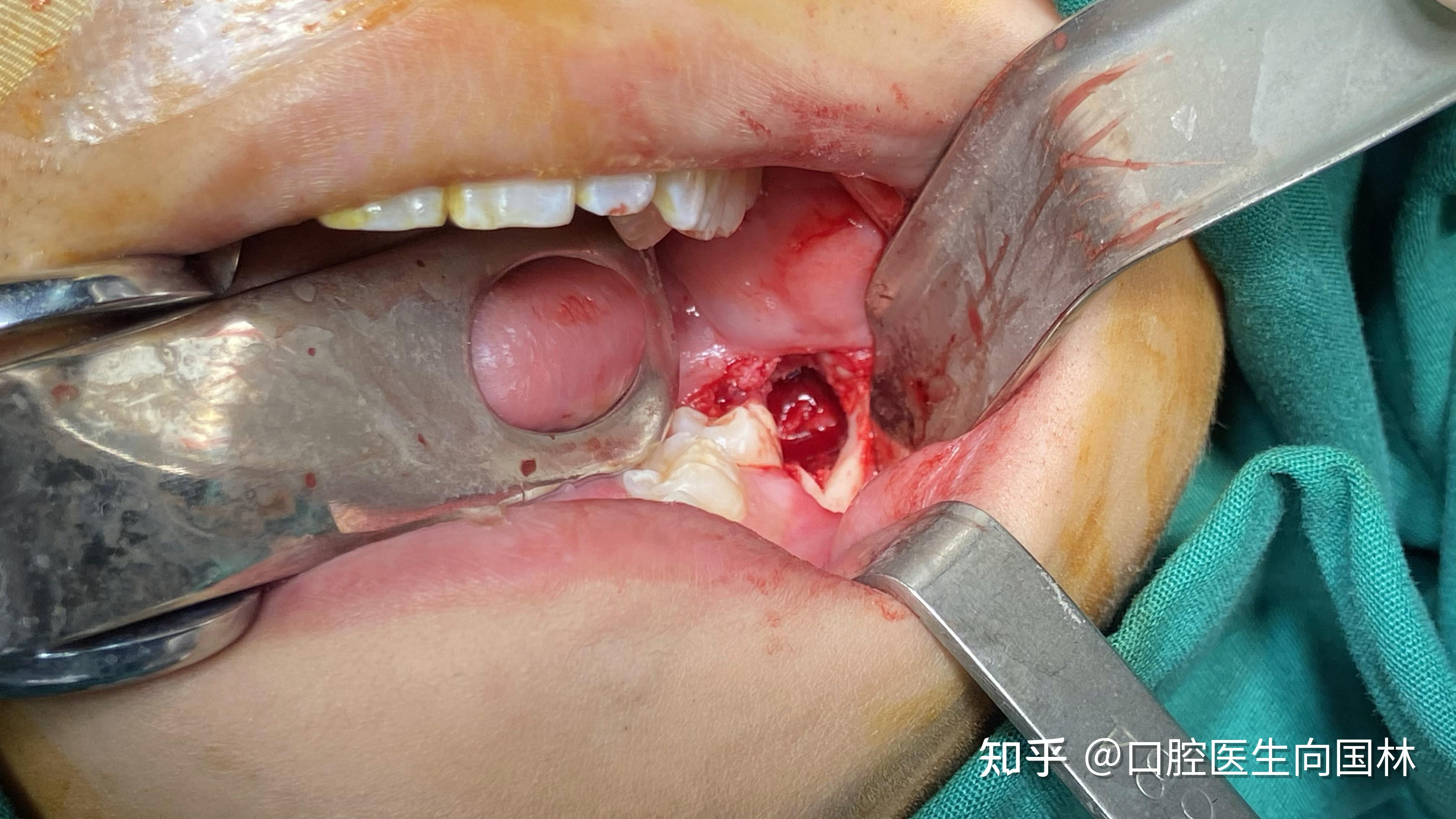 口腔医院颌面外科案例:38埋伏阻生智齿超声骨刀拔除 下颌骨囊肿摘除
