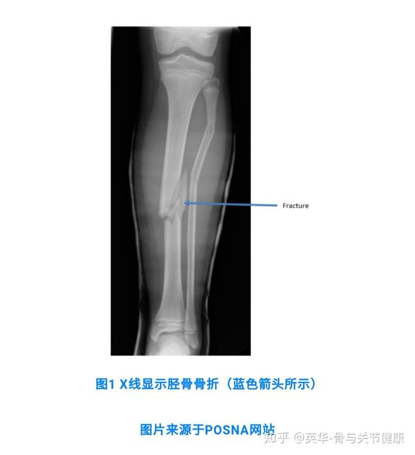 胫骨骨折tibialshaftfractures
