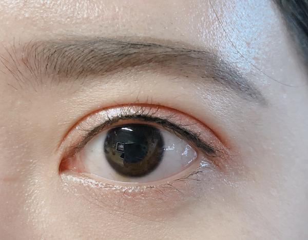 割双眼皮失败是什么样子的?