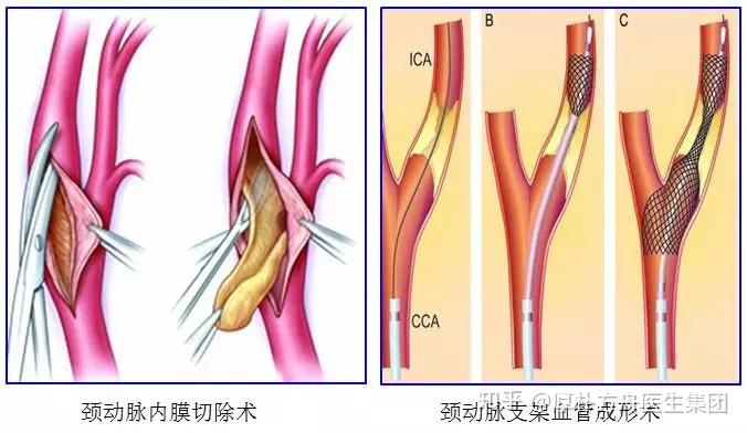 颈动脉内膜切除术是通过外科手段切除或剥脱导致颈动脉管腔狭窄或