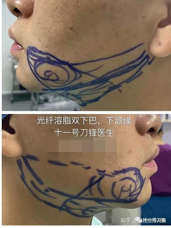 吸脂 光纤溶脂:医生在嘟嘟肉处注射膨胀液,目的是把脂肪细胞和其他