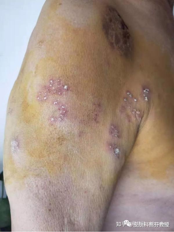 蛇缠腰能使用糖皮质激素吗