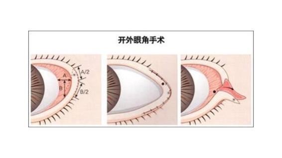 外眼角有必要开吗 zhuanlan.zhihu.com