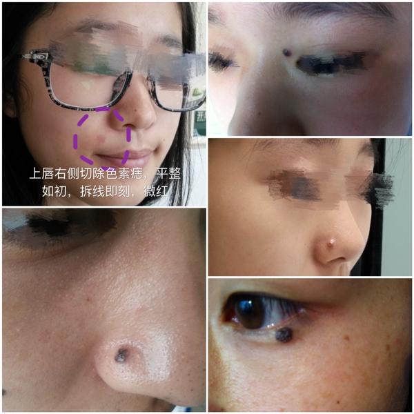 点痣点出恶性黑色素瘤