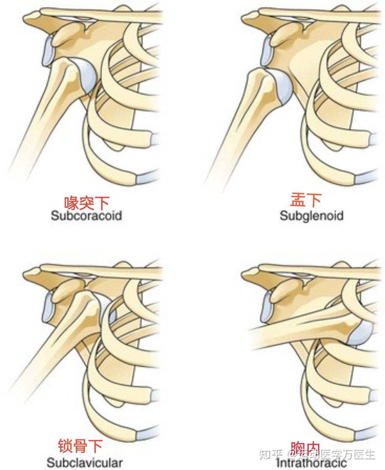 8年制外科学肩关节脱位分型图示是不是错了
