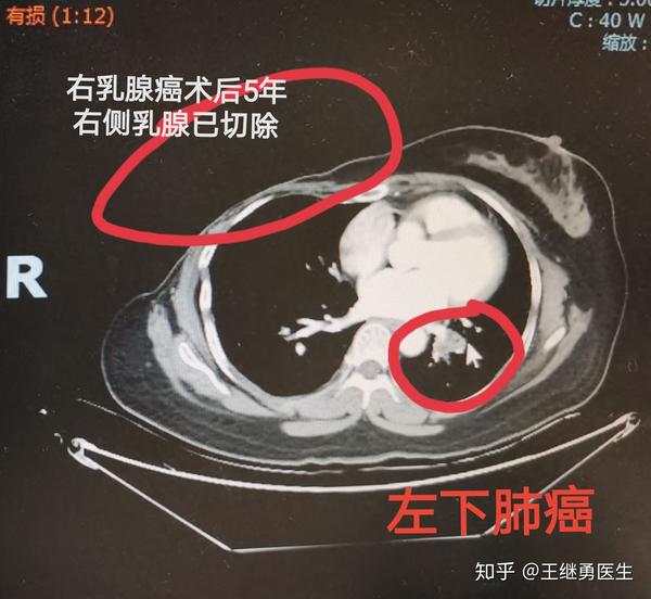 乳腺癌患者术后复查为什么一定要每年做胸部ct?