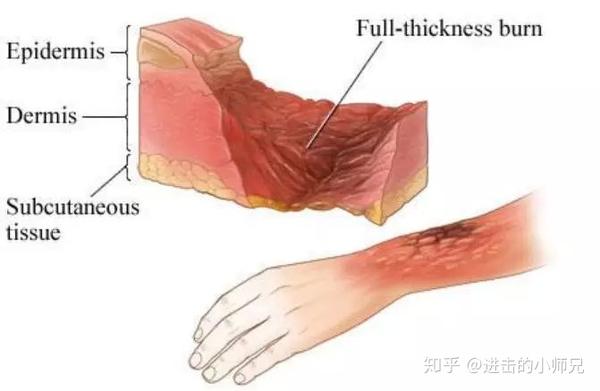 护士必会小技巧之烧伤面积计算