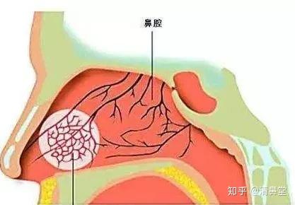 清鼻堂科普:鼻子为什么会不通气?是鼻炎导致的吗?