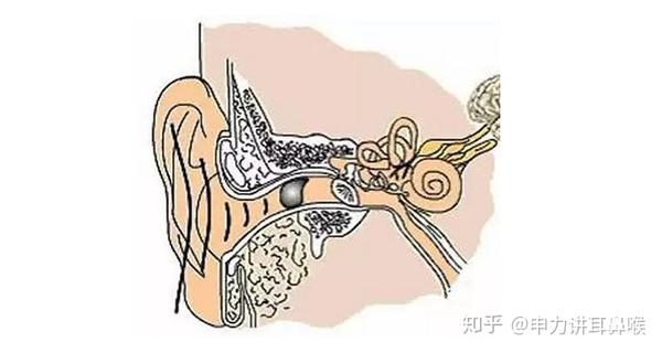 我耳朵里有耳屎一定是耵聍栓塞吗