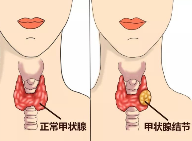 很多人在检查发现自己有甲状腺结节的时候,很害怕,担心肿瘤会恶变成