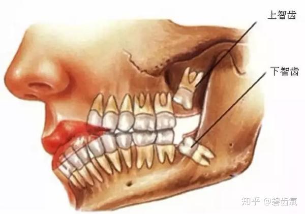 足够间隙提供给所有牙齿正常萌出,最后萌出的智齿就会发生阻生和错位