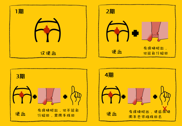 首先来看一下痔疮分期: 如果你仅仅有便血,痔疮没有脱出,这属于一期.