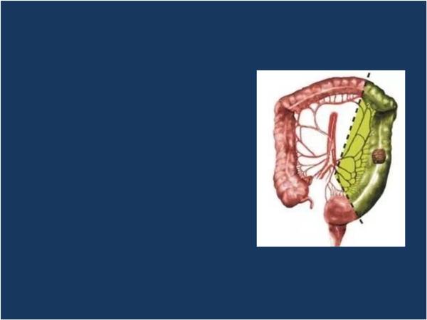 腹腔镜结肠癌根治术-检查分析