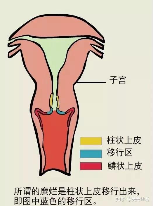 的称呼,现在 早已经被教科书删除,取而代之的是 「宫颈柱状上皮异位」