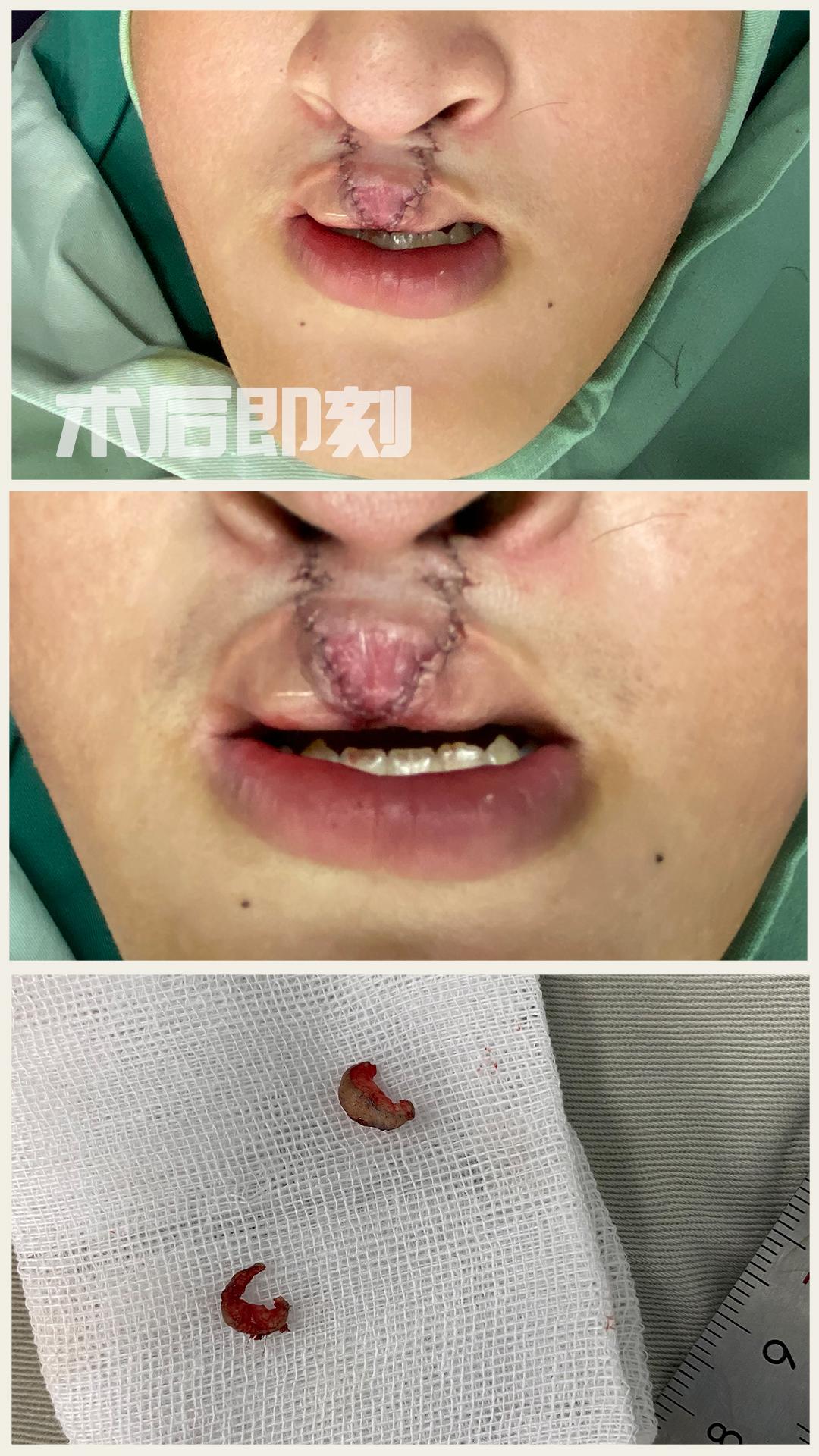 首发于兔唇修复 微信:yuwenlin01现任高尚医学美容中心院长.