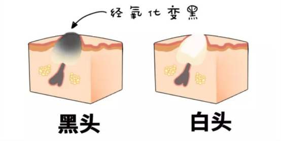 名门泽佳怎么去黑头用牙膏消灭黑头的效果不错