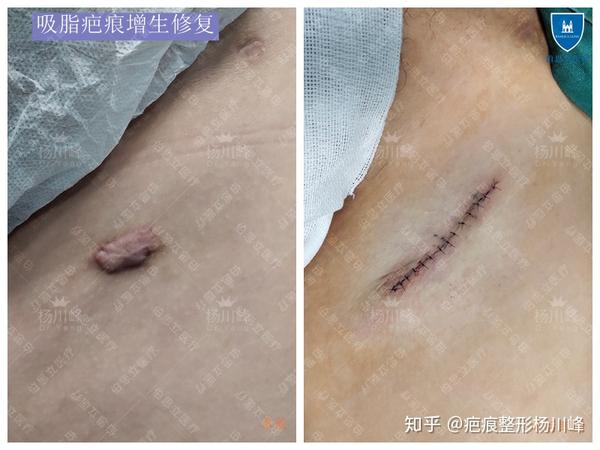 大腿吸脂术后严重的疤痕增生修复